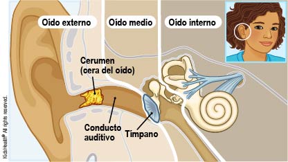 Cerume o cera del oído ¿Puede el exceso de cerumen causar pérdidas de audición?